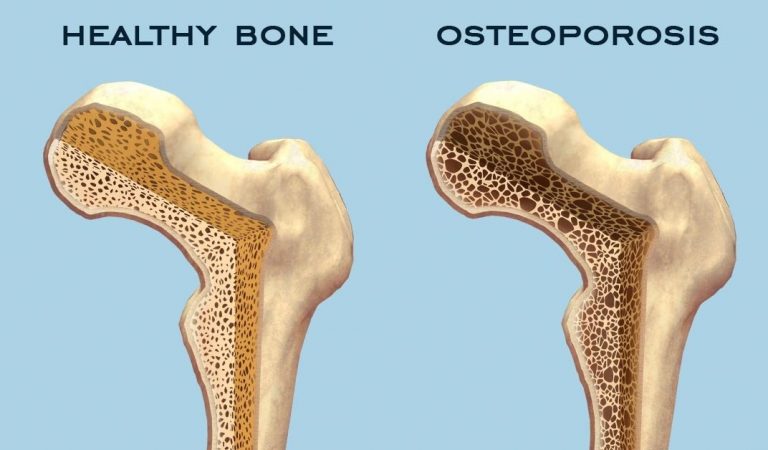 Osteoporosis: Symptoms, diagnosis and treatment options